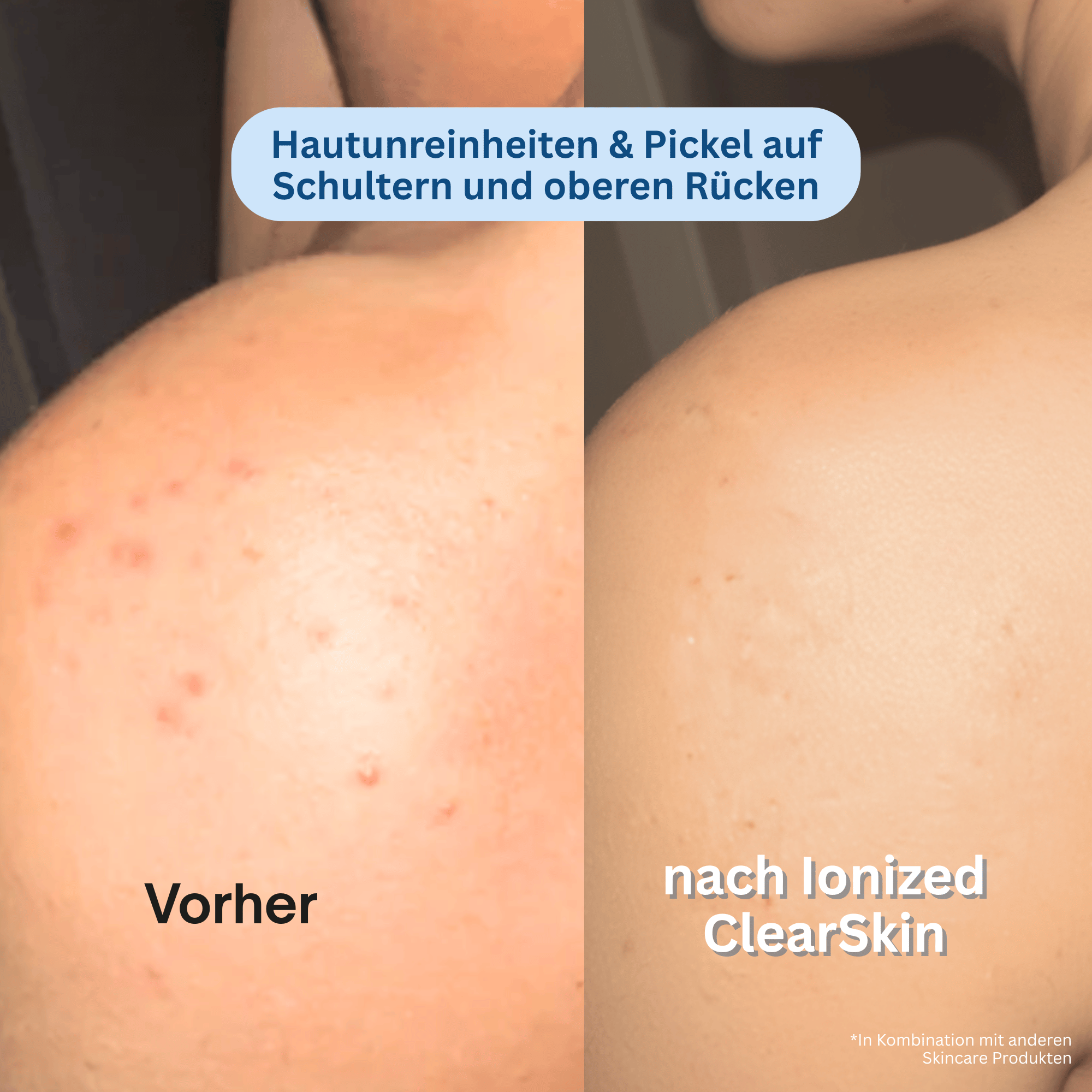 Ionized™ ClearSkin Peeling Duschtuch - Pickel / Akne