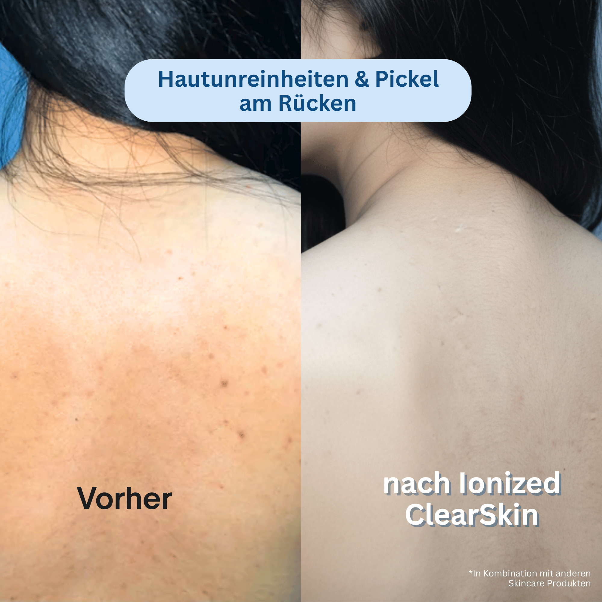 Ionized™ ClearSkin Peeling Duschtuch - Every Day