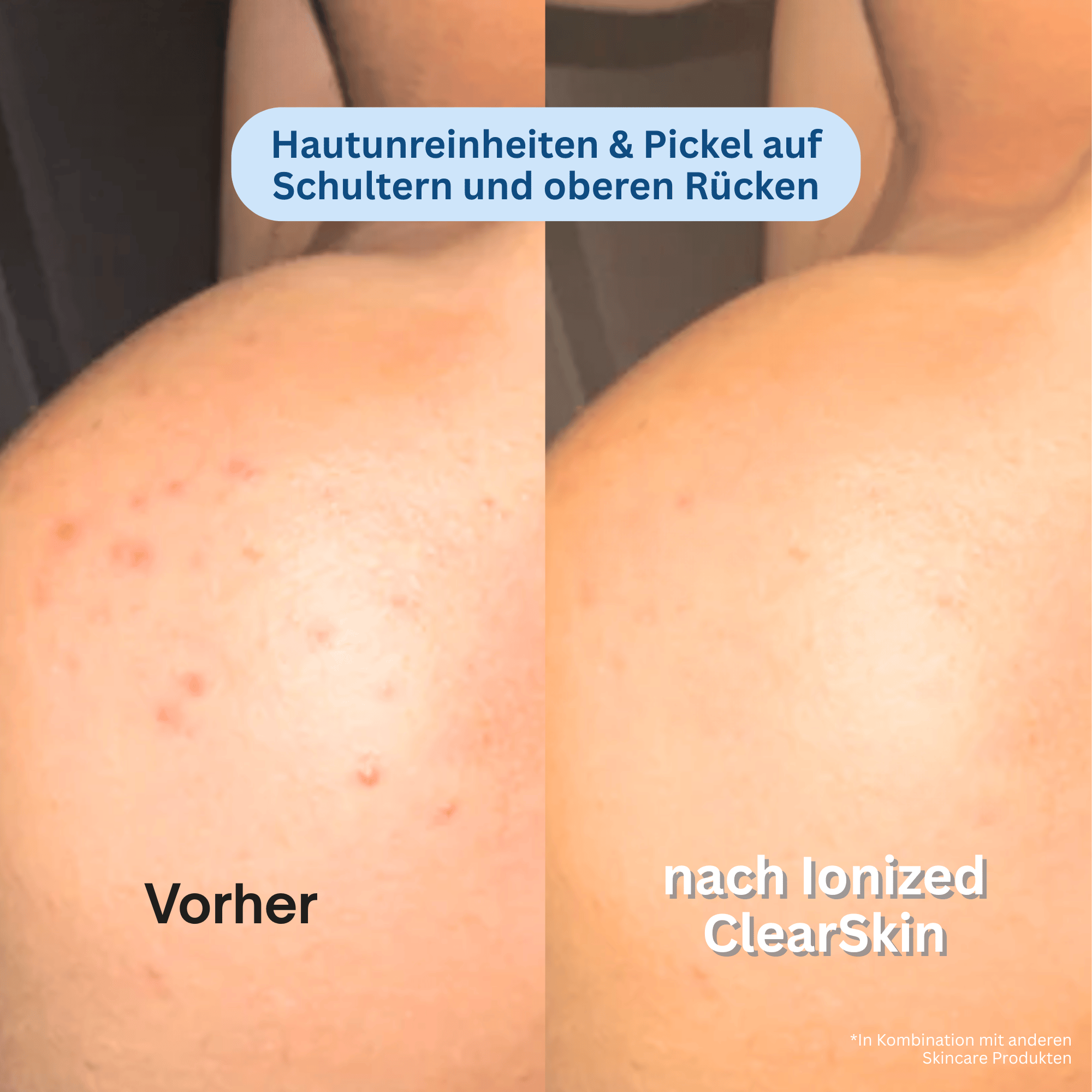 Ionized™ ClearSkin Peeling Duschtuch - Full Routine