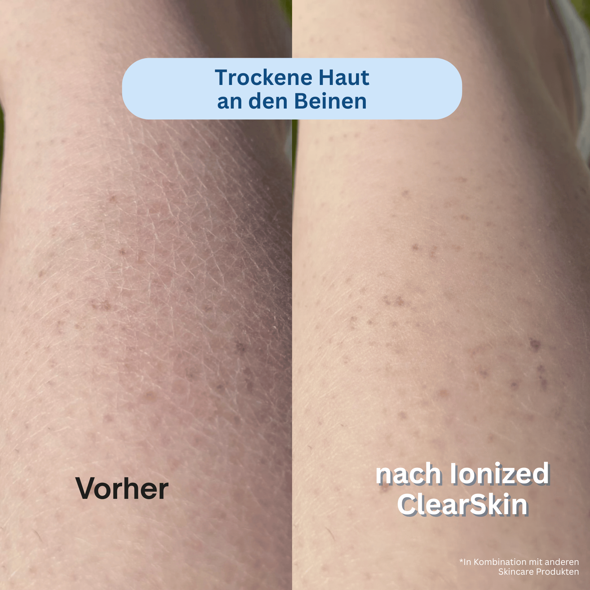 Ionized™ ClearSkin Peeling Duschtuch - Full Routine