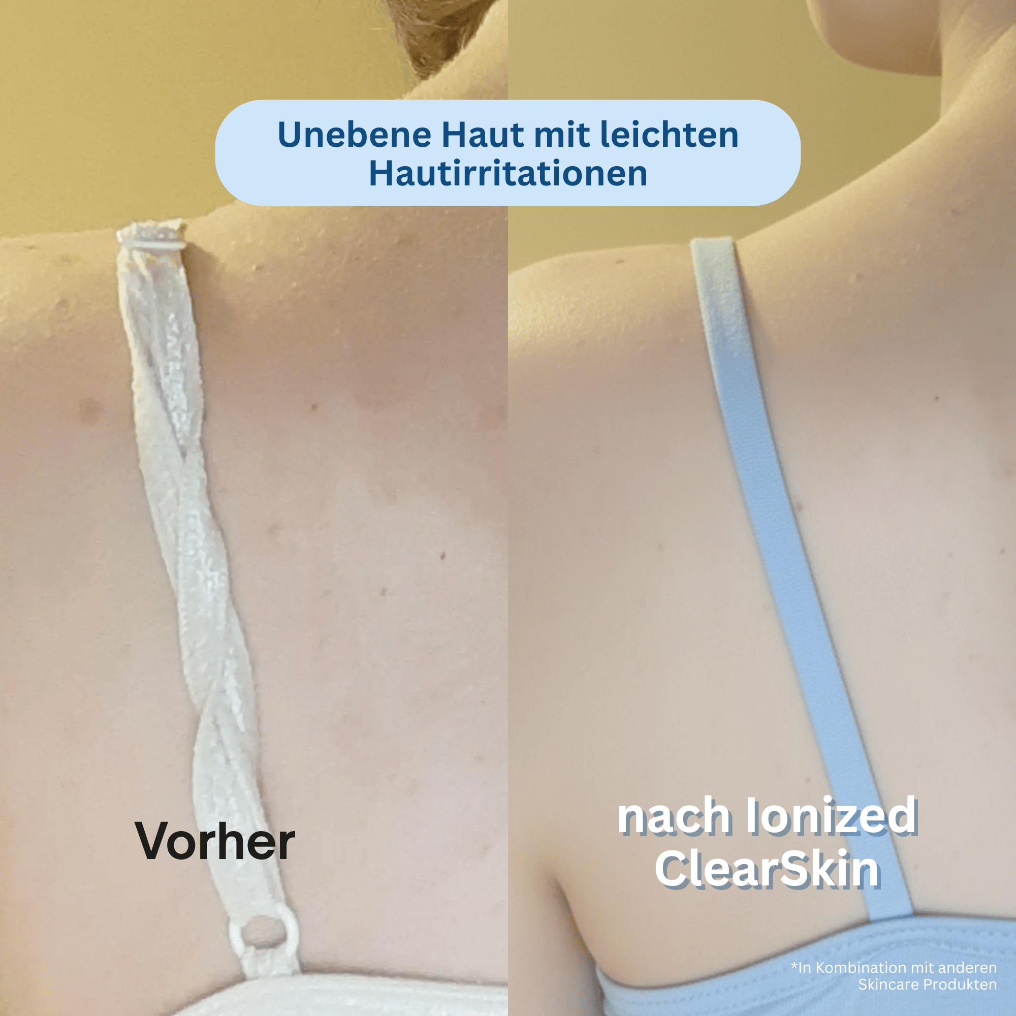 Ionized™ ClearSkin Peeling Duschtuch - Trockene & Unreine Haut