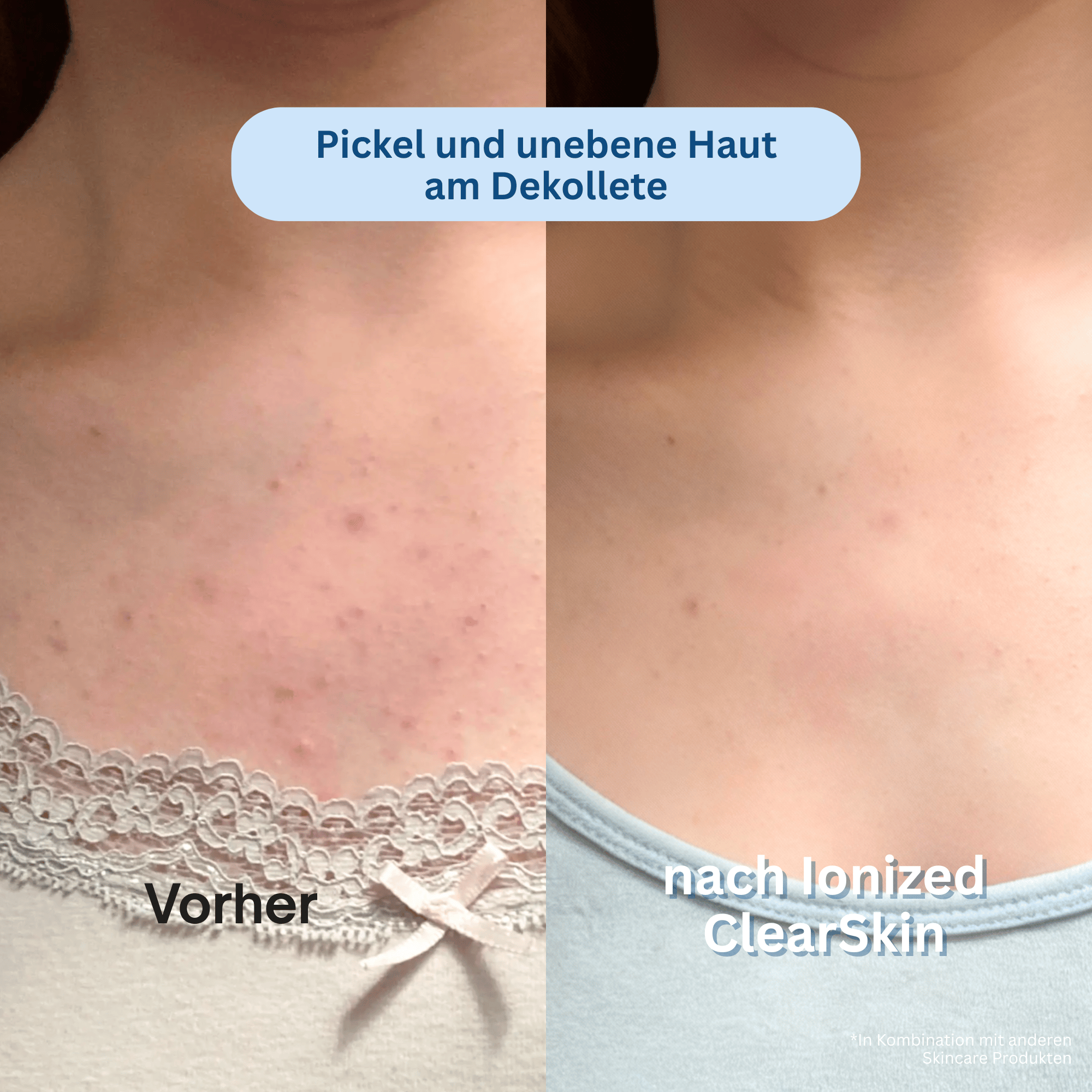 Ionized™ ClearSkin Peeling Duschtuch - Full Routine
