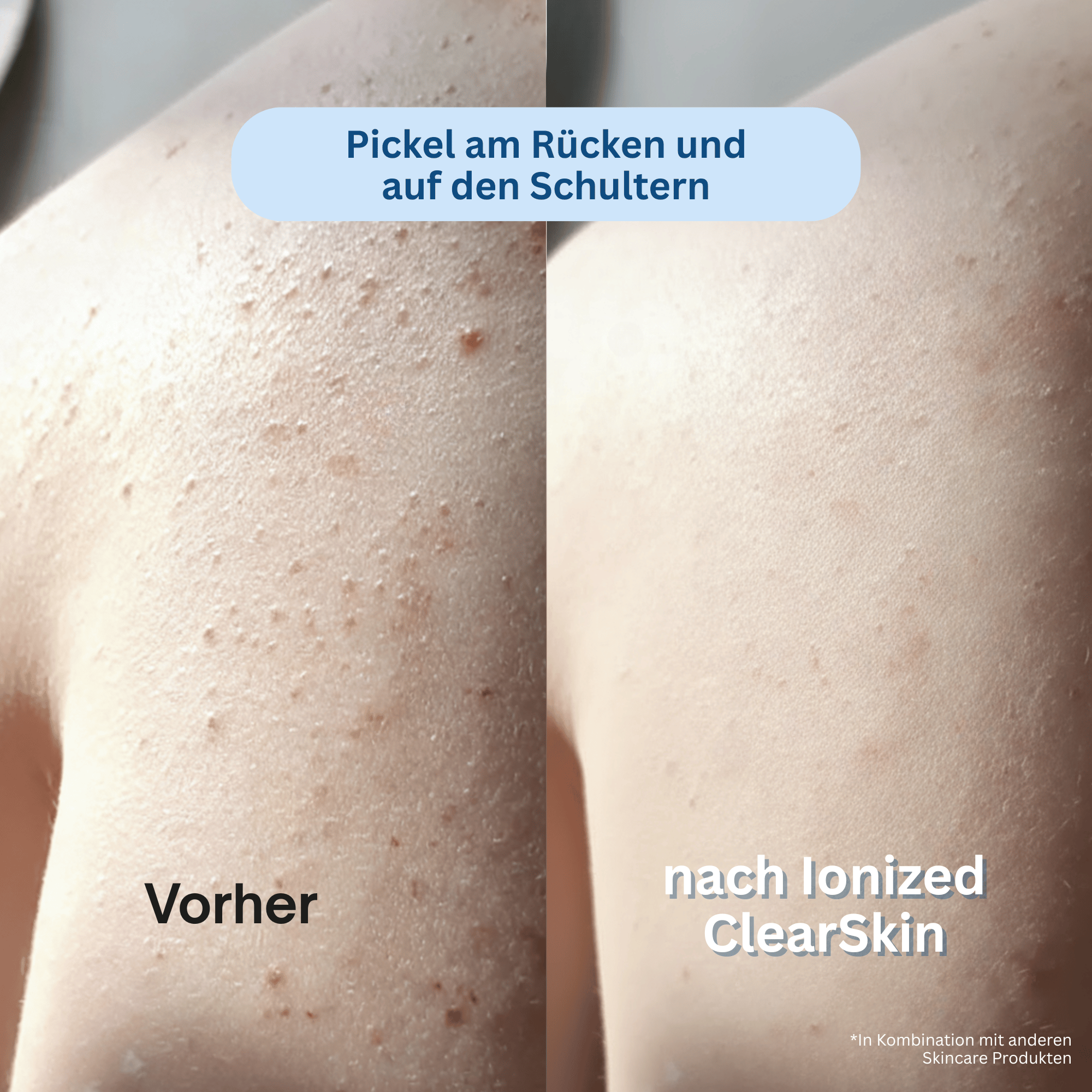Ionized™ ClearSkin Peeling Duschtuch - Pickel / Akne