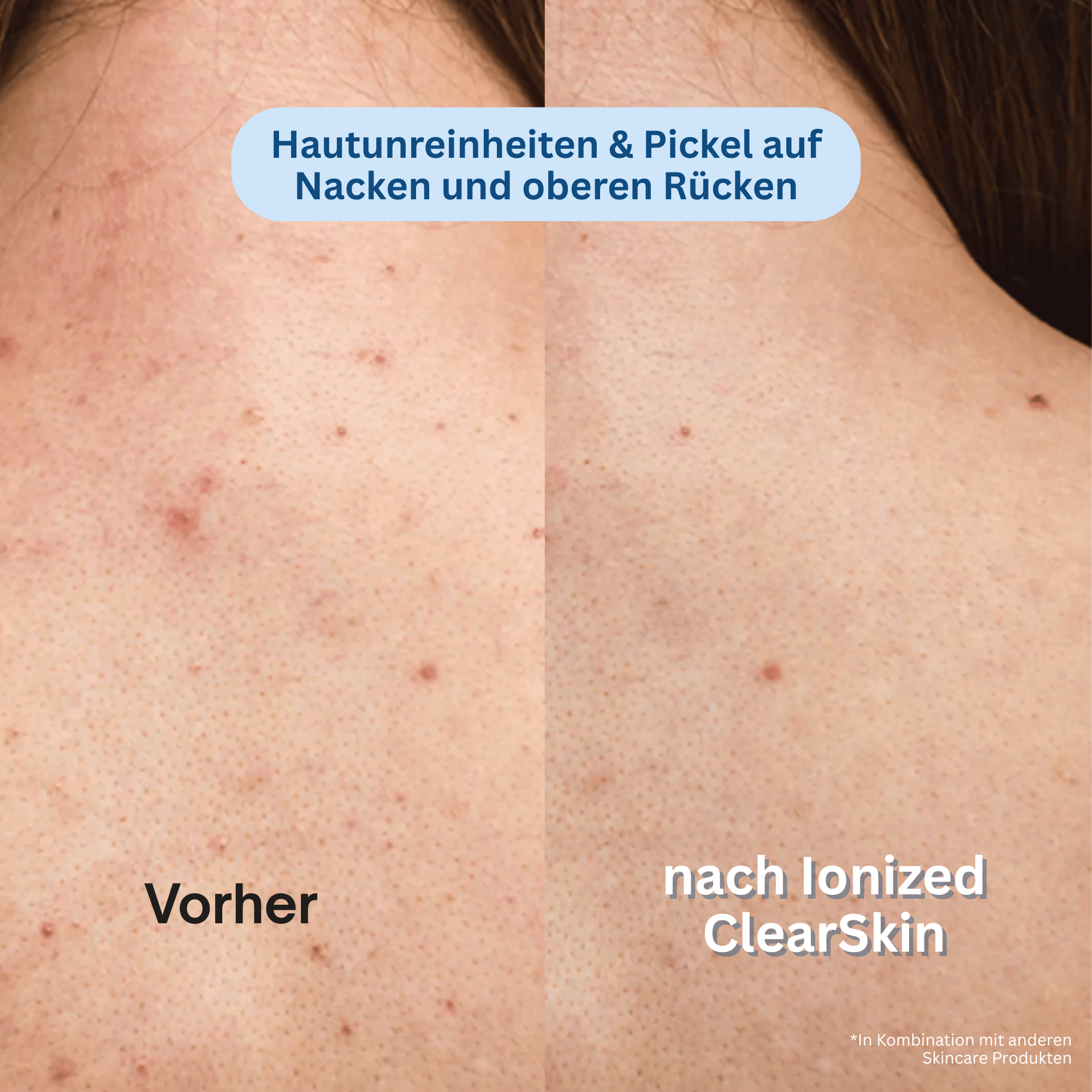 Ionized™ ClearSkin Peeling Duschtuch - Every Day