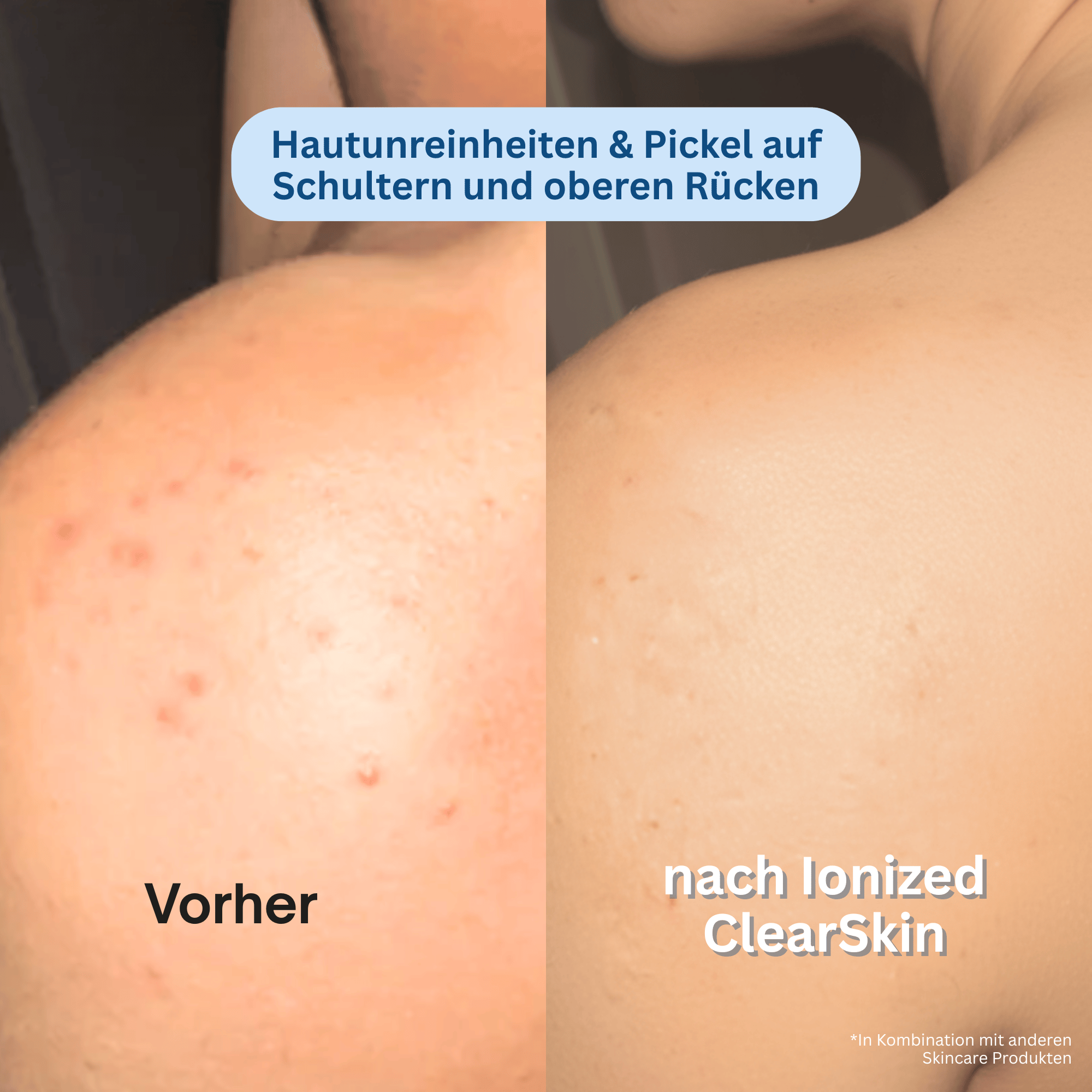 Ionized™ Peeling Duschtücher - Full Routine