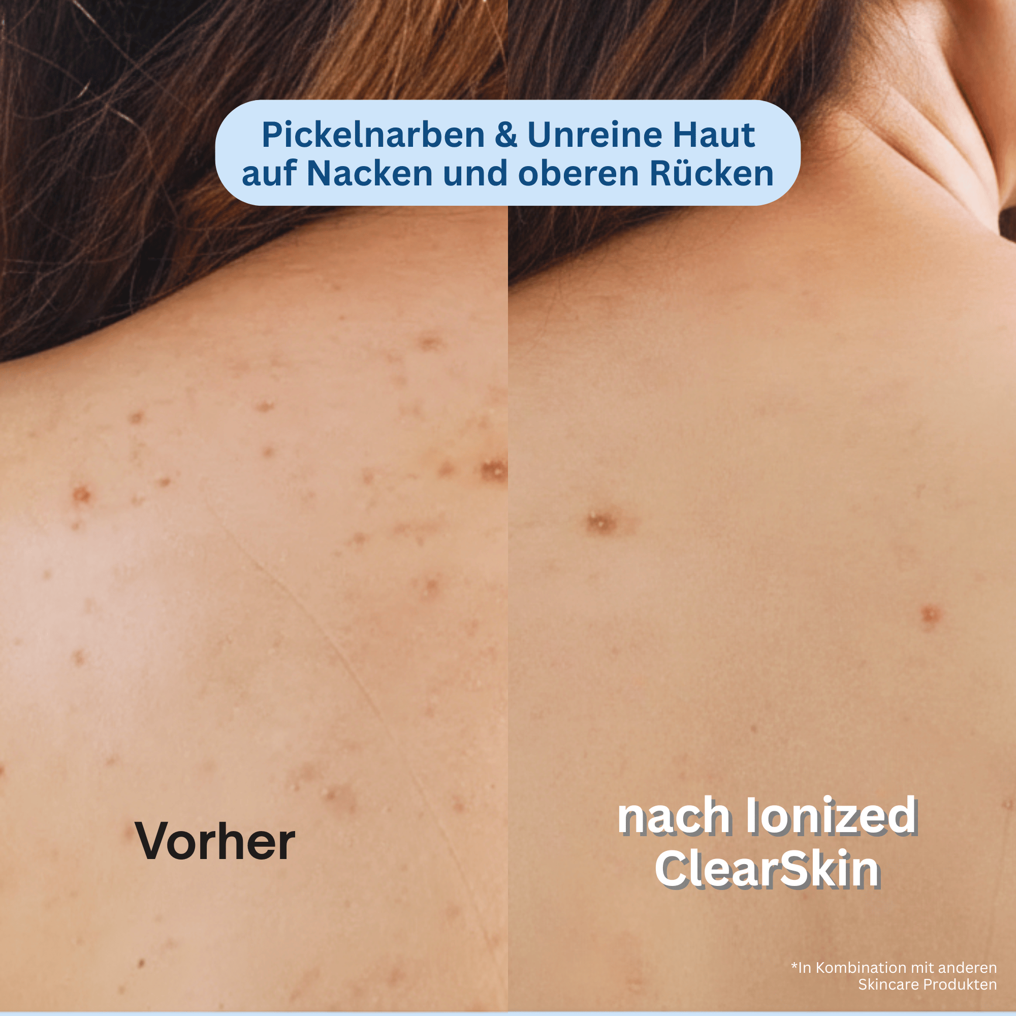 Ionized™ ClearSkin Peeling Duschtuch - Pickel / Akne