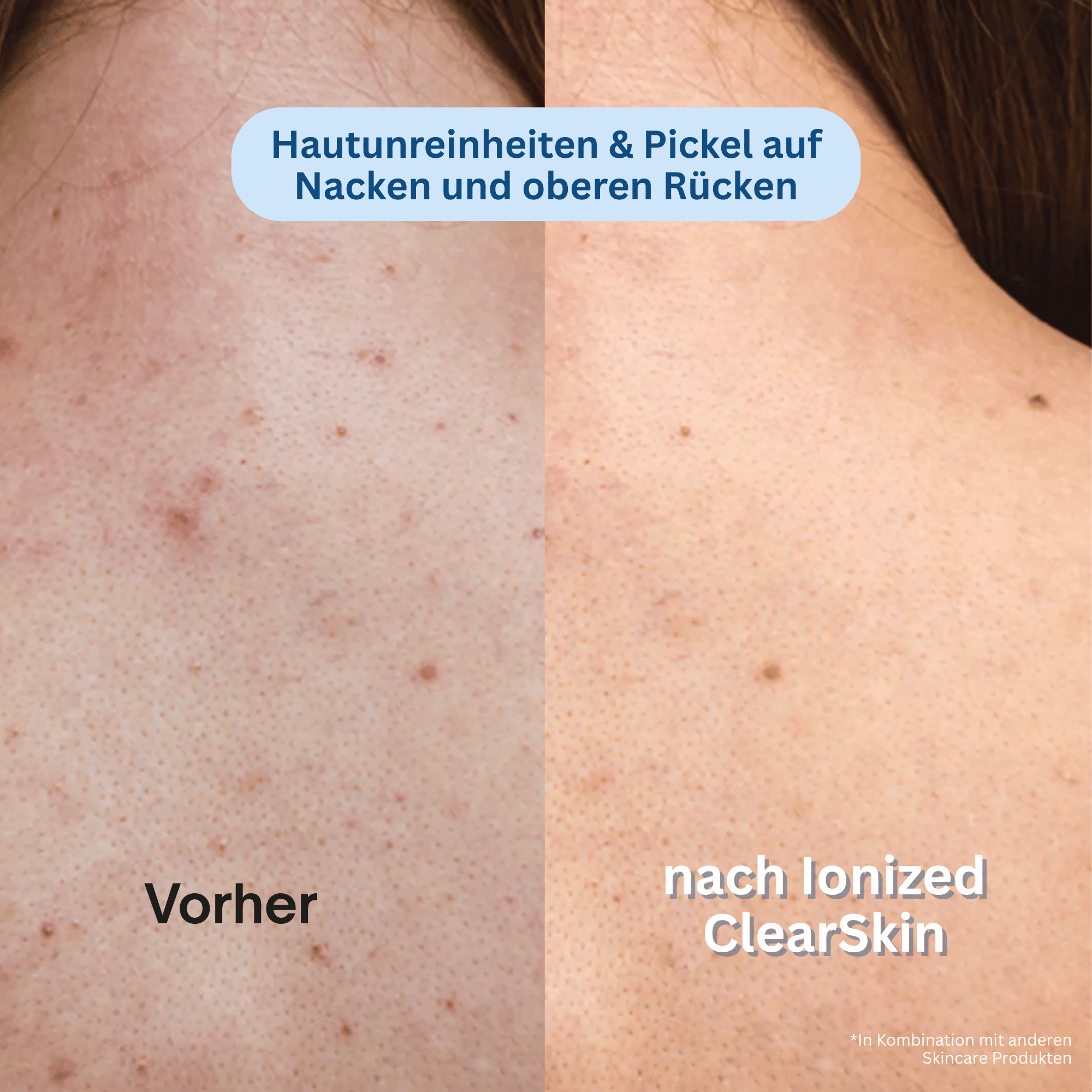 Ionized™ ClearSkin Peeling Duschtuch - Pickel / Akne