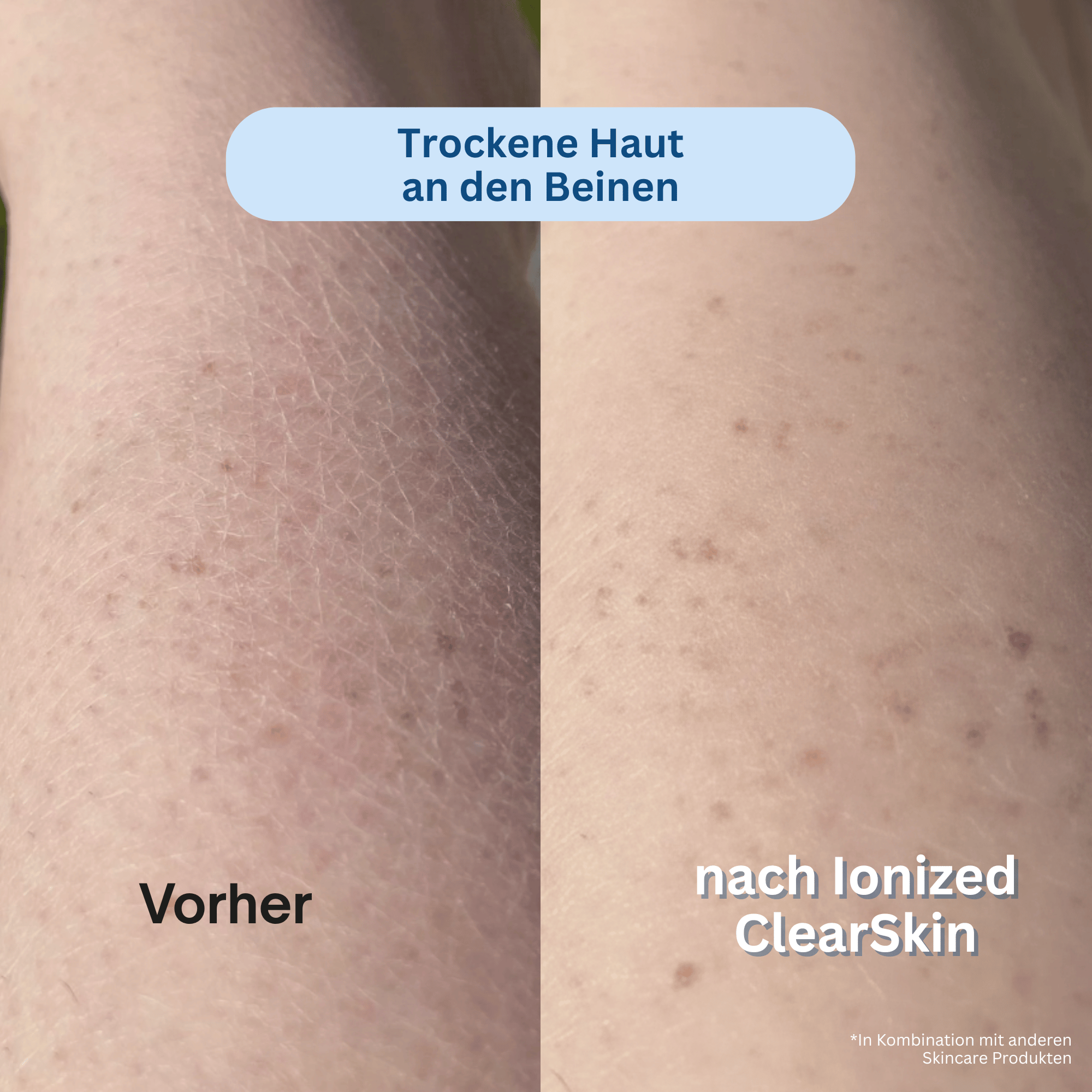 Ionized™ ClearSkin Peeling Duschtuch - Trockene & Unreine Haut