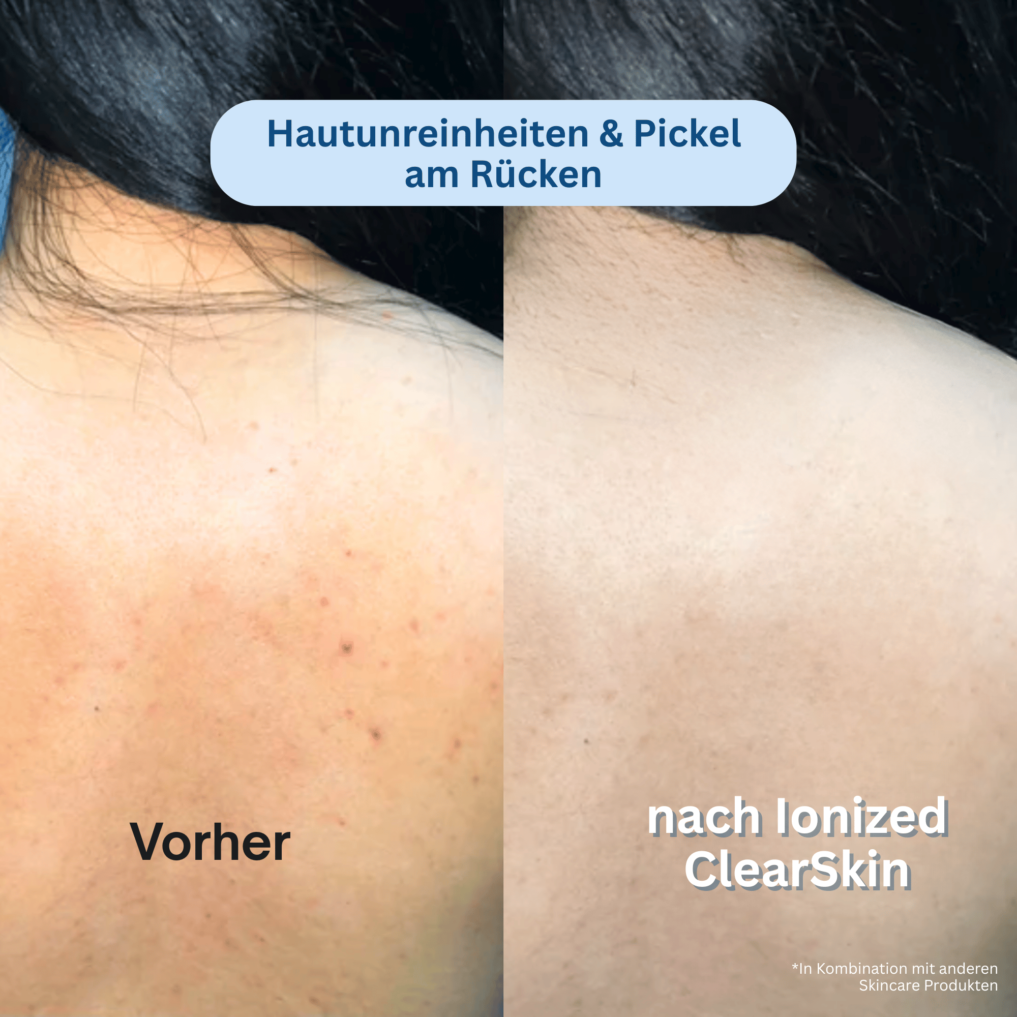 Ionized™ ClearSkin Peeling Duschtuch - Full Routine
