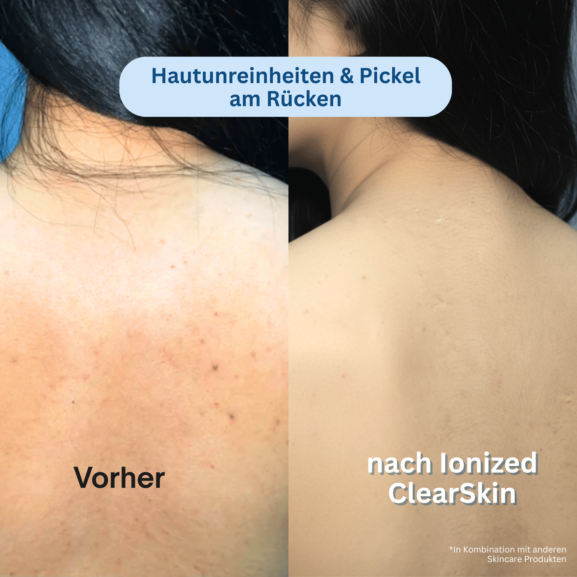 Ionized™ ClearSkin Peeling Duschtuch - Trockene & Unreine Haut